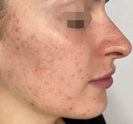 Pina Panchal MD acne scars_5 treatments before